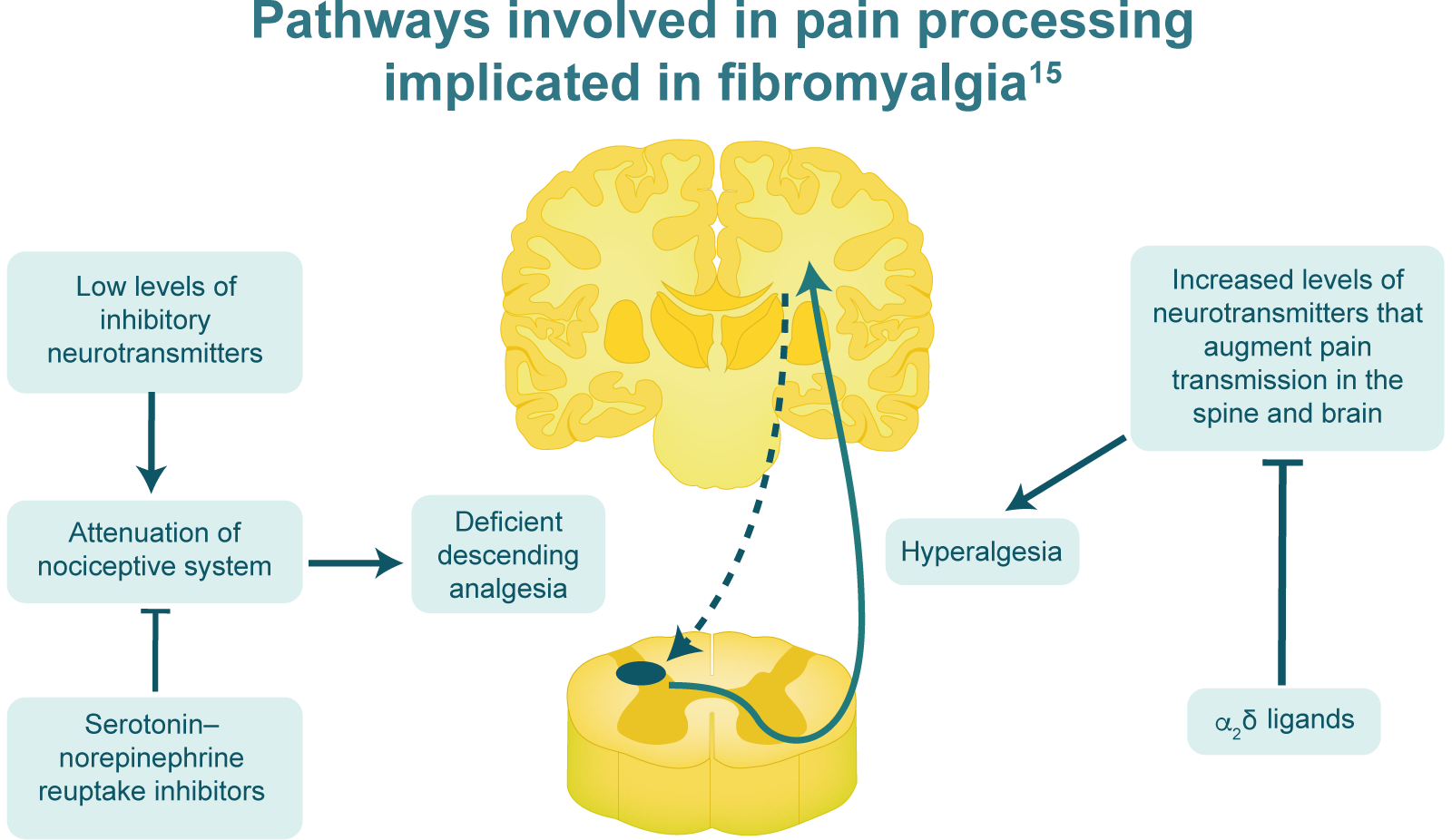 Pathways involved in pain processing implicated in fibromyalgia