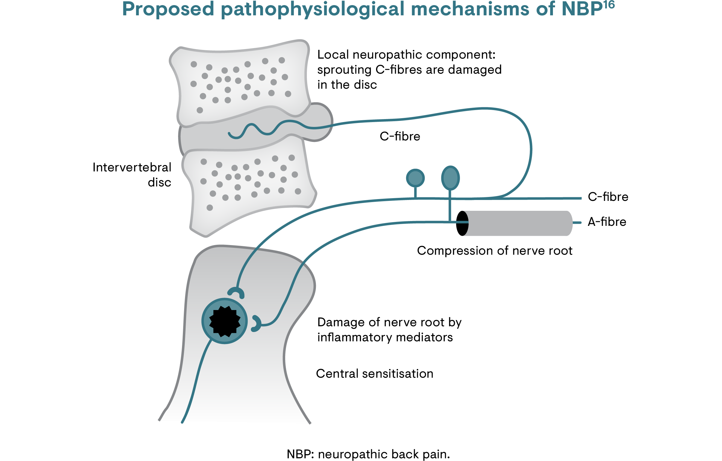 Graphical representation of the proposed pathophysiological mechanism of neuropathic back pain (NBP)